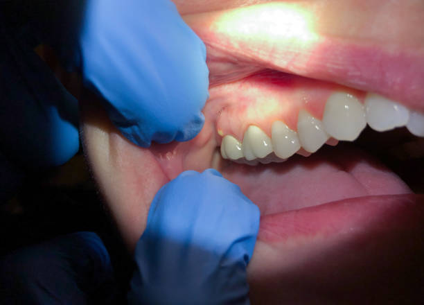 Best Emergency Tooth Extraction in Louisa, KY
